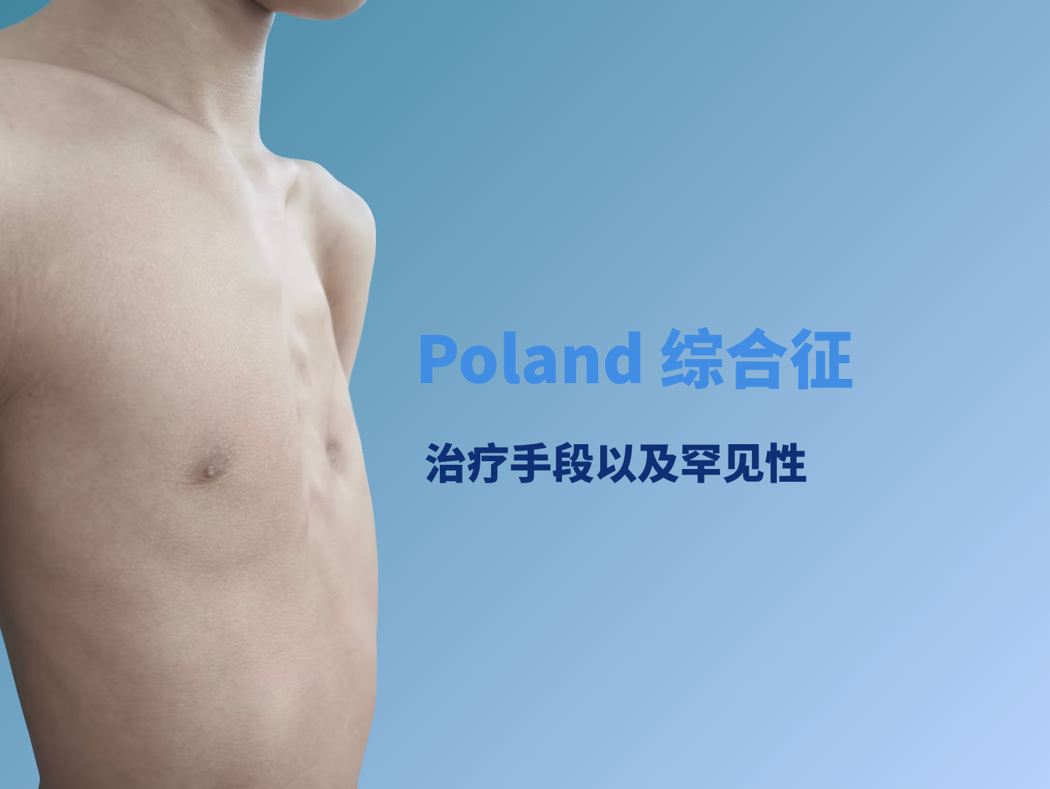 Poland综合征罕见吗？该如何治疗？