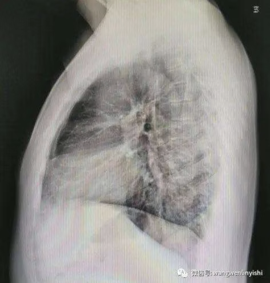 X线提示重度胸廓畸形