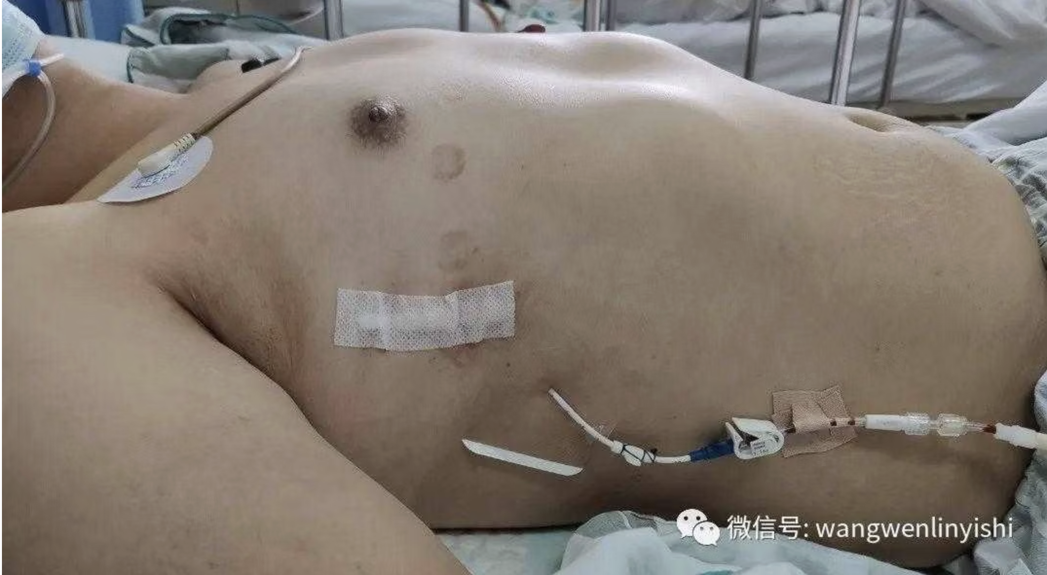 术后胸廓外观基本恢复正常