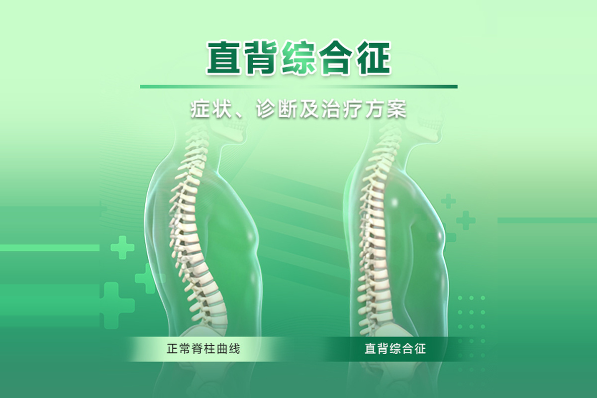 什么是直背综合征？常见症状与治疗选择